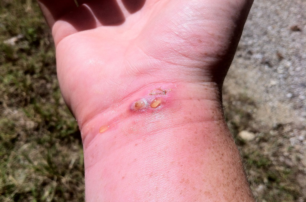 infection